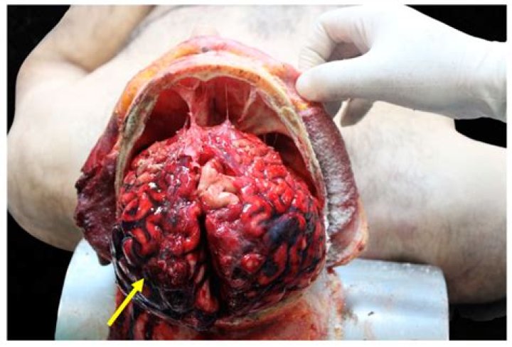 Exploring The Fascinating Anatomy Of Tarrare