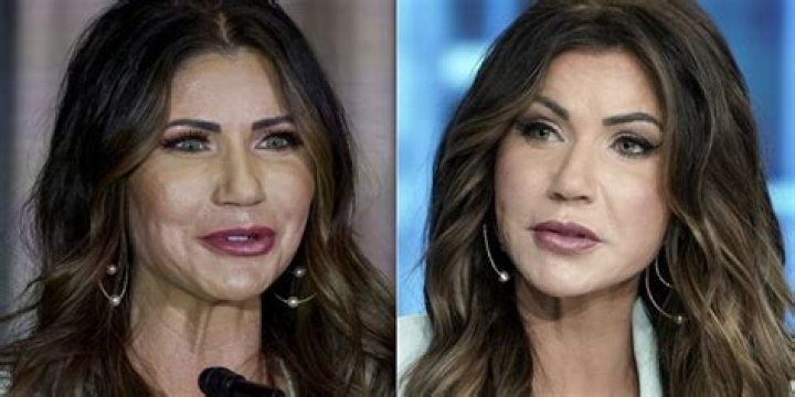Kristi Noem's Appearance Before Surgery: A Transformation Revealed