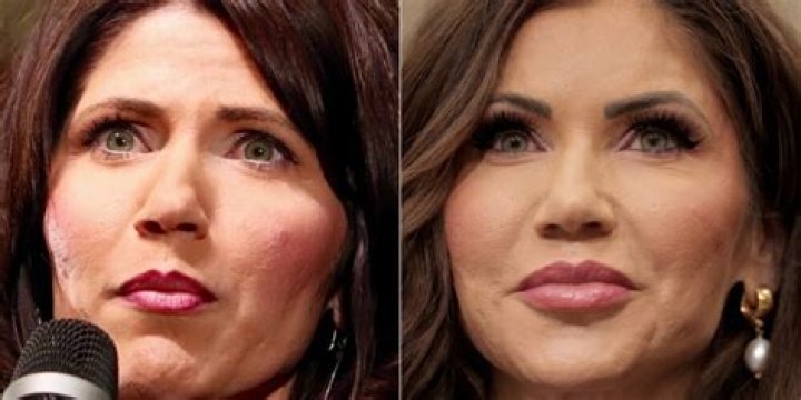 Kristi Noem's Transformation: Plastic Surgery Before And After