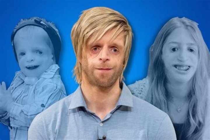 Meet The Extraordinary Individuals With Treacher Collins Syndrome: Famous Faces Of Resilience