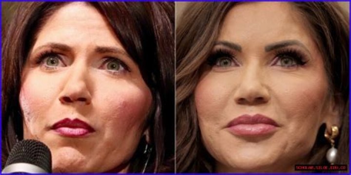 The Transformation Of Kristi Noem: Before And After Plastic Surgery Reveal