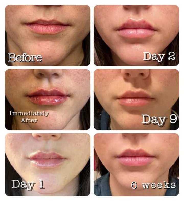 The Ultimate Guide To Kristi Noem Filler: From Procedure To Results