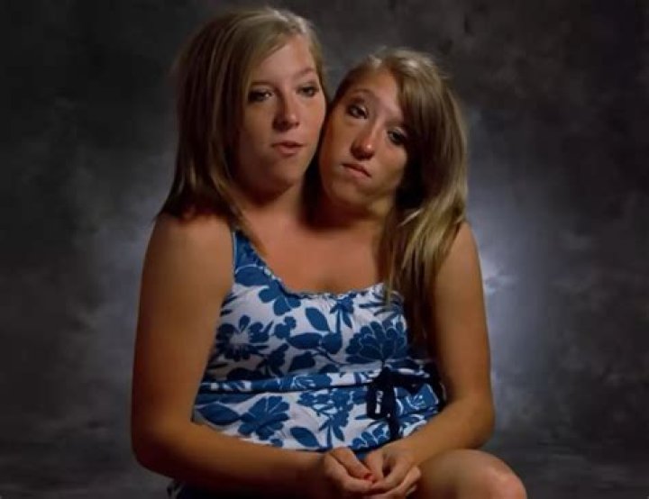 Tragic Journey Of Conjoined Twins: Abby And Brittany