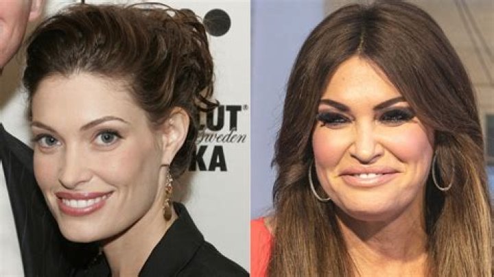Transformations In The Spotlight: Kimberly Guilfoyle's Face Before And After