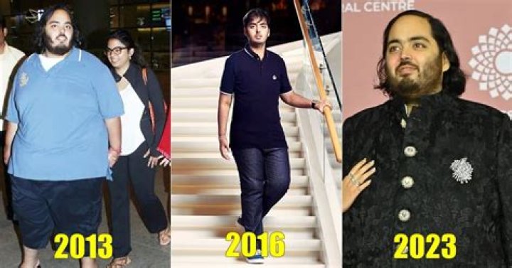 Understanding Anant Ambani And Down Syndrome
