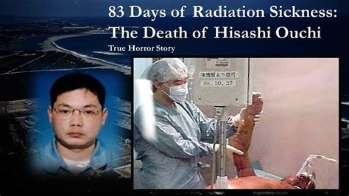 Unveiling The Tragic Legacy Of Hisashi Ouchi Through Medical Images