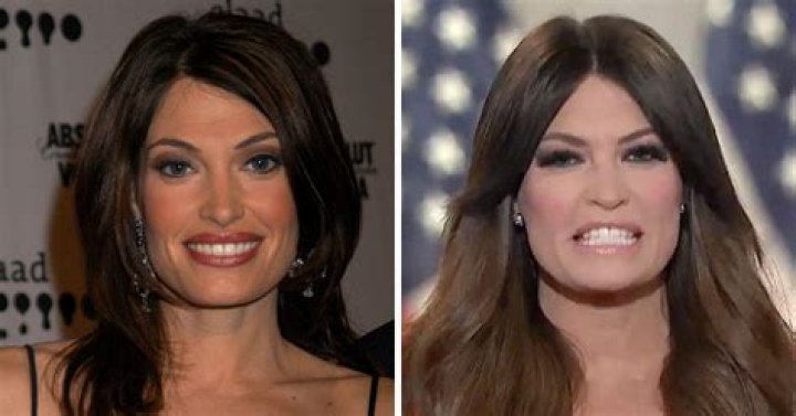 Unveiling The Truth Behind Kimberly Ann Guilfoyle's Plastic Surgery Journey