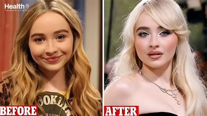 Unveiling The Truth: Does Sabrina Carpenter Have Lip Filler?